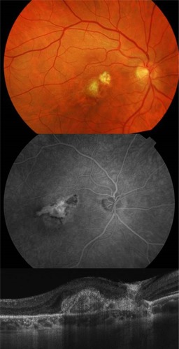 Figure 3 Spectral-domain optical coherence tomography confirmed reduction of the choroidal neovascularization activity with a central macular thickness of 275 μm and disappearance of the retinal hemorrhage. Leakage from the choroidal neovascularization in the fluorescein angiography had ceased.