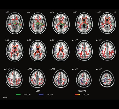 Supplementary Figure 4. Differences in white matter and gray matter in Turner syndrome (TS). Superimposed results of voxels showing significant fractional anisotropy (FA) reduction in the tract-based spatial statistics (TBSS) and voxel-based morphometry (VBM) clusters showing significant white matter volume (WMV) differences between the groups (P< 0.05, familywise error rate corrected). Group differences in TBSS were “thickened” (for visualization purposes) by expanding the significant white matter skeleton cluster to the full extent of the local FA map. 1) FA reduction in TS relative to controls (CON) is shown in red-yellow. 2) Greater WMV in TS relative to CON is shown in green. 3) Reduced WMV in TS relative to CON is shown in blue. Results are mapped onto a standard T1 -weighted Montreal Neurological Institute 152 template. Reproduced from ref 160: Yamagata B, Barnea-Goraly N, Marzelli MJ, et al. White matter aberrations in prepubertal estrogen-naive girls with monosomic Turner syndrome. Cereb Cortex. 2012;22:2761-2768. Copyright © Oxford University Press 2012