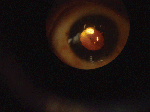 FIGURE 2  Anterior Segment Biomicroscopy - Uveitis with Posterior Synechia.