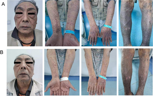 Figure 3 Patient’s skin condition after the second FMT (A); after the third FMT (B).