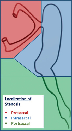 Figure 3. Localization of stenosis in regard to the lacrimal sac.