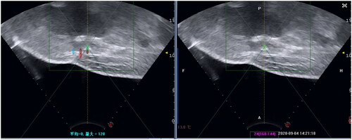 Figure 3. HIFU Treatment (Sept. 04th, 2020). The image showed the mass during HIFU.