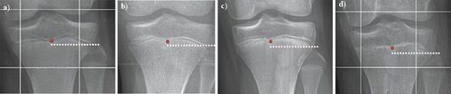 Figure 2. Radiological assessment of the center of the proximal tibial growth plate and the tip of the proximal fibula in order to measure dPTFH in different aged patients (a = 10 years, b = 12 years, c = 14 years, d = 16 years). While closer to skeletal maturity the growth plate appears less distinct (d), in general its outlines can still be estimated.