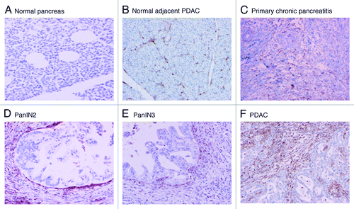 Figure 4. Representative galectin-1 staining of pancreas tissue microarrays. All ductal epithelial cells and neoplastic cells were negative for galectin-1 staining. The positive staining was detected in the stromal cells for galectin-1 positive specimens. A. Normal pancreas (no staining); B. Normal pancreas adjacent to PDAC (1+); C. Primary benign chronic pancreatitis (1+); D. PanIN 2 (2+); E. PanIN3 (2+); F. PDAC (3+).