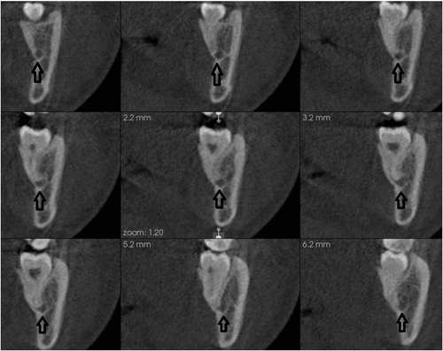 Figure 3. The MC is visible on nine slices (open arrow), therefore, was given a score of 3 (excellent visibility).