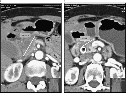 Figure 2.  Computed tomography scan of the upper abdomen depicting the size of the tumour before radiochemotherapy (a) and 4 weeks after the completion of therapy (b). Note the increased patency of the splenic vein following treatment.