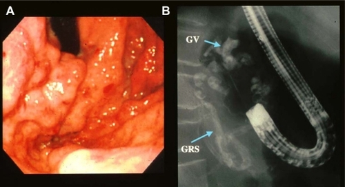 Figure 2 A) Endoscopic image that reveals F3, Lg-cf varices with erosion. B) Image of endoscopic obliterative therapy under fluoroscopy using 70% Histoacryl in this patient.