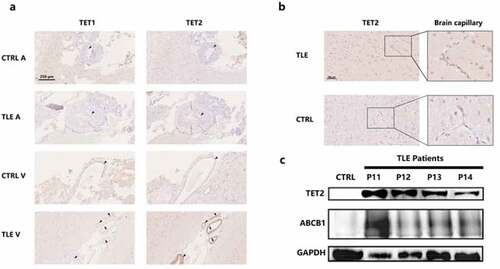 Figure 2. Differential involvement of TET1, TET2, and ABCB1 in the cerebral vasculature of the neocortex. a. Expression patterns of TET1 and TET2 in the veins and arteries of the temporal cortex in TLE patients and controls. Arrow heads indicate the endothelial structure of the cerebral vasculature. Scale bars are equal to 250 μm. b. TET2 staining in brain capillaries with amplification of the temporal cortex of TLE patients and controls. Scale bars are equal to 100 μm. c. Western blot showing TET2 and ABCB1 expression in isolated brain capillaries of TLE patients (P11-P14) and controls. V, vein; A, artery; TLE, temporal lobe epilepsy; CTRL, control.