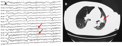 Figure 1 EEG showed epileptiform discharge (red arrows) and Chest CT showed a tumor in the hilus of the left lung (red arrow).