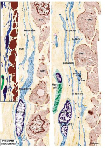 Figure 5. Representative ultrathin section of human pregnant myometrium. SMCs are shown in cross-section and were digitally colored brown. In their vicinity, numerous Telocytes are observed (blue) [Citation35].