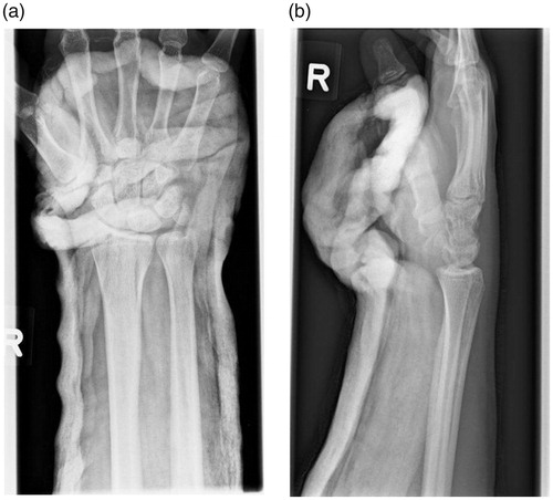 Figure 2. (a) X-ray (anteroposterior view) of the right hand after an unsuccessful manual closed reduction. (b) X-ray (lateral view) of the right hand after an unsuccessful manual closed reduction.