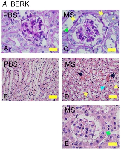 Figure 3 Morphine treatment exacerbates renal pathology in BERK mice. Kidney sections from BERK mice treated with PBS or MS for 6 weeks. (A and C) Glomeruli stained with PAS to show the basement membrane. Note that the tubules in PBS-treated mice are lined with intact epithelium and a brush border. In morphine-treated mice (C), the glomerulus is much larger than that in PBS-treated and shows parietal cell metaplasia (green arrow); tubules show basement membrane without epithelial cells (left yellow arrow) or epithelial cells sloughing off of the basement membrane (right yellow arrow) with a proteinaceous deposit (yellow *). Parietal epithelial cell metaplasia can be seen more prominently at the higher magnification in (E) (green arrow). In (D), the H&E-stained images show prominent vascular congestion (black arrows), early tubular epithelial cell necrosis (left yellow arrow), loss of epithelial cells and brush border (right yellow arrow), and proteinaceous deposits (turquoise arrow).