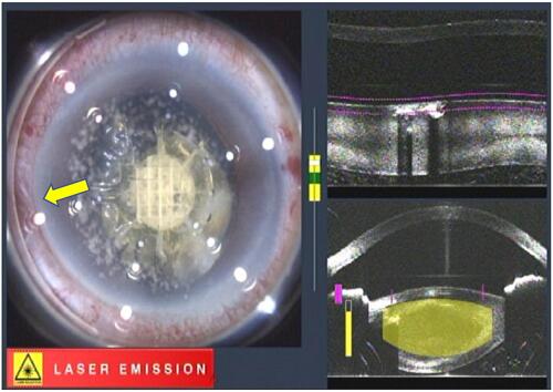 Figure 3 During lens fragmentation, the bubble is still observed (yellow arrow).