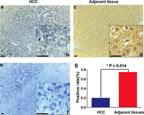 Figure 6. Immunohistochemical staining of MIP protein in HCC and corresponding adjacent tissues. (a,b) Weak cytoplasmic expression of MIP in HCC tissue; (c,d) strong nuclear and cytoplasmic expression of MIP in the corresponding adjacent tissue; (e,f) negative control by replacing the anti-MIP primary antibody with PBS in the HCC tissue; (g) comparison of the positive MIP immunohistochemical staining rate in 20 paired samples of HCC and adjacent tissues.