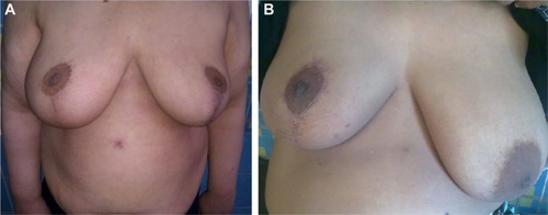 Figure 3 Therapeutic mammoplasty.