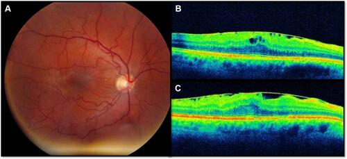 Figure 2 This 58-year-old male demonstrates a typical idiopathic epiretinal membrane with macular involvement and prominent macular thickening. The initial best-corrected visual acuity (BCVA) was 20/40 and the final BCVA was 20/20 after cataract surgery. (A) Fundus photograph; (B) baseline OCT image, horizontal cut; (C) OCT image after 24 months of follow-up.