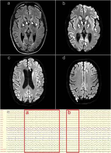 Figure 1. A-D: magnetic resonance imaging of the brain showing typical features of Creutzfeldt-Jakob disease: hyperintensity of the caudate nuclei and putamina on fluid-attenuated inversion recovery imaging (panel a, arrowheads) and diffusion restriction within the bilateral striatum, right fronto-temporo-insular cortex, left fronto-parietal cortex and bilateral occipital cortex on diffusion-weighted imaging (panels b-d, arrows). e: electroencephalographic recording showing typical features of Creutzfeldt-Jakob disease. a longitudinal montage is depicted. Subcontinuous generalized triphasic periodic sharp-wave complexes can be seen on this segment, with a 1–2 Hz discharge rate (a); during the short interruptions in periodic sharp-wave complex firing, a diffusely slowed background activity in the theta range can be observed (b).