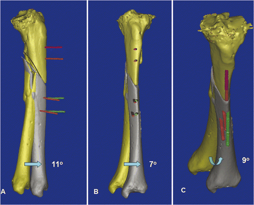 Figure 5. In a virtual simulation of a corrective osteotomy, the proximal and distal segments of the tibia were separated. The distal tibia (yellow) was mobilized from its original deformed position to its corrected position (gray). The final position was determined by assessing the mechanical axis of the two tibial segments, the continuity of the anterior tibial crest, and also the knee and ankle joint lines. The deformity could then be quantified, and was measured as 11° procurvatum (A), 7° varus (B) and 9° rotational deformity (C). To facilitate the deformity correction, parallel alignment pins were planned at the proximal tibia (two red pins) and the distal tibia in the corrected position (two green pins). The distal tibia (gray) and the green alignment pins were moved together and back to the original deformed position. The locations of the distal alignment pins on the deformed distal tibia (two red pins) were defined.