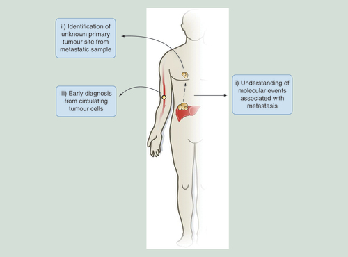 Figure 4.  Genome-wide 5-hydroxymethylcytosine analysis as a diagnostic tool in cancer.Examples for how 5hmC-based studies can aid in probing of molecular events that occur in metastasis, resulting in the identification of primary tumor sites distinct from metastatic samples or be adapted for novel early stage diagnostic tools through the study of circulating tumor cells in the bloodstream.5hmC: 5-hydroxymethylcytosine.