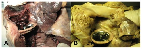 Figure 4 (A) Thrombi found in the right atrium and ventricle in control group; (B) There was no thrombus found in heart in experimental group.