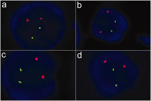 Figure 2. Fluorescence in situ hybridization of bone marrow samples for myelodysplastic syndrome. (a) 99% cells showed two green and two red signals with GLP D5S23, D5S72\EGR1 probe, indicating that the patient was without absence of 5q31. (b) 99% cells showed two green and two red signals with GLP D5S23, D5S72\CSF1R probe, indicating that the patient was without absence of 5q33. (c) 98% cells showed two green and two red signals with GLP D7S486, D7S522/CSP7 probe, indicating that the patient was without absence of chromosome 7. (d) 99% cells showed two green and two red signals with GLP D20S108/CSP8 probe, indicating that the patient was without absence of chromosome 8 and 20q12.