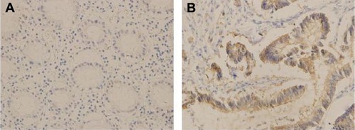 Figure 1 Expression of Gal-3 in nontumor tissue adjacent to carcinoma (A) and colorectal cancer (B).