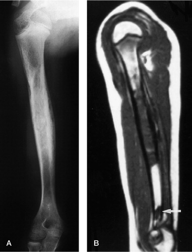 Figure 1. Ewing's sarcoma of the left humerus, demonstrating the primary and skip lesions on both radiographs (A) and MR scan (B).
