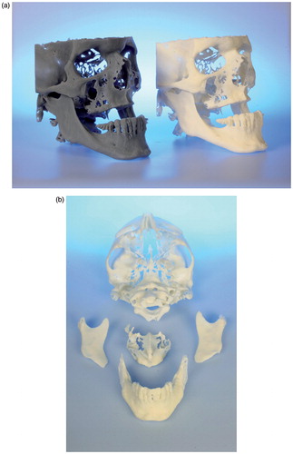 Figure 2. (a–c) CBCT-based models of the first clinical case, with a class III malocclusion and an edentulous maxilla (the models are available in different versions). A two-jaw model surgery was required for correct alignment of the alveolar processes prior to implant insertion. (d–e) The clinical situation before and after orthognathic correction supported by CBCT-based models.