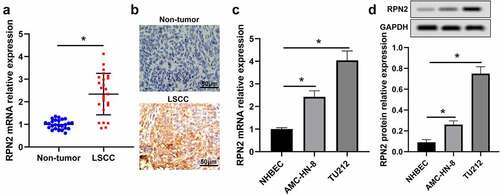 Figure 1. RPN2 expression was augmented in human LSCC tissues and cells. (a) qRT-PCR assay for RPN2 mRNA expression in 25 paired LSCC tissues and adjacent non-tumor samples. (b) IHC analysis for the protein level of RPN2 in collected human samples. RPN2 mRNA (c) and protein (d) levels were detected in LSCC cell lines (TU212 and AMC-HN-8) and normal human bronchial epithelial NHBEC cells. *P < 0.05.