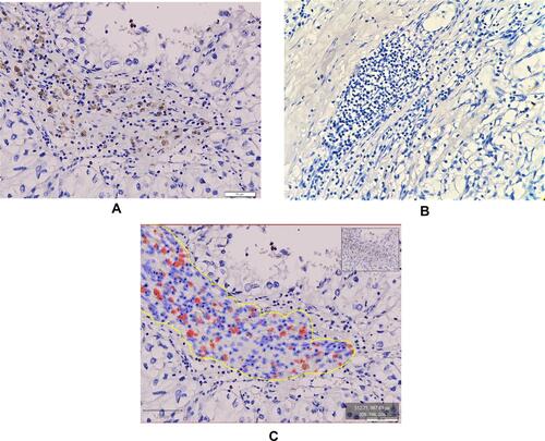 Figure 2 (A) Positive PD-L1 immunoexpression in clear cell renal cell carcinoma (IHC;400x). (B) Negative PD-L1 immunoexpression in clear cell renal cell carcinoma (IHC;400x). (C) PD-L1 SP142 scoring system on immune cells using QuPath 0.2.3 digital software (IHC;400x).