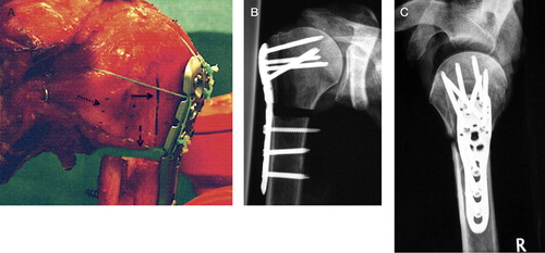 Figure 2. A. Unstable 3-part fracture model with fiber-cerclages of the proximal humerus intact rotator cuff. Fracture gap I (à) and II (- ->). Three point-pairs (….>) for measurement of rotator cuff strain. B. AP and C. axillary views of an unstable 3-part-fracture model.