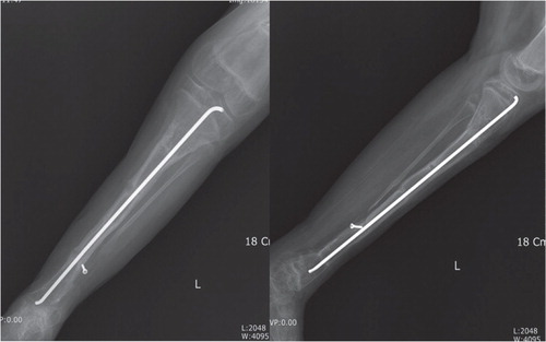 D. Anteroposterior and lateral radiographs of the child 2 years after surgery, showing well-united tibia with acceptable axial alignment.
