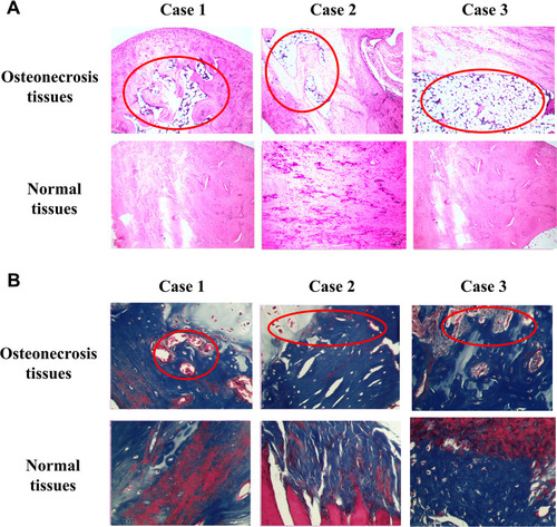 Figure 1 The pathological characteristics of osteonecrosis of the femoral head. (A) H&E staining. (B) Masson’s staining. Three cases represented samples selected randomly from three individuals. Scale bar = 50 μm.