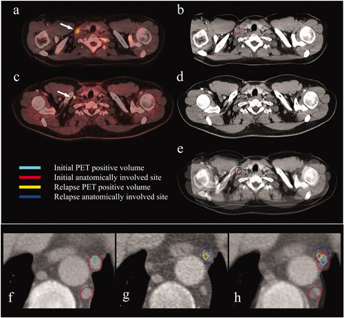 Figure 1. Rigid co-registration of the staging- and relapse scans for two patients (a–e and f–h). (a) Staging PET/CT-scan. Arrow pointing to an initially involved PET positive supraclavicular lymph node. (b) CT part of the staging PET/CT-scan. Delineation of the PET positive (cyan) and the anatomically involved volume (red). (c) Relapse PET/CT-scan. Arrow pointing to a PET positive relapsed supraclavicular lymph node. (d) CT part of the relapse PET/CT-scan. Delineation of the PET positive (yellow) and the anatomically involved volume (blue). (e) Fusion of the staging- and the relapse PET/CT-scans. The relapse is in the exact same lymph node as initially involved. (f) CT part of the staging PET/CT-scan. Delineation of a PET positive (cyan) and two anatomically involved mediastinal lymph nodes (red). (g) CT part of the relapse PET/CT-scan. Delineation of a PET positive (yellow) and anatomically involved (blue) mediastinal lymph node. (h) Fusion of the staging- and the relapse scans. The relapse is in the exact same lymph node as initially involved.CT: computed tomography; PET: positron emission tomography.