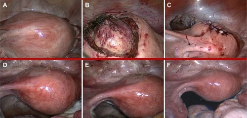 Figure 2 Laparoscopic features: intraoperative (A–C) and 6 months after surgery (D–F).