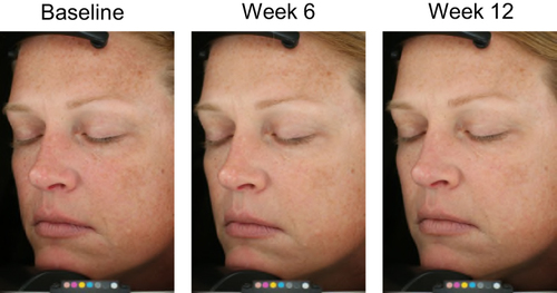 Figure 6 Improvements in appearance of hyperpigmented skin after 6 and 12 weeks of DGR. The participant pictured was a 43-year-old woman with Fitzpatrick Skin Type I, under Standard lighting.