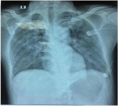 Figure 1 X-ray image of the patient’s lung immediately after 10 minutes of the surgery.