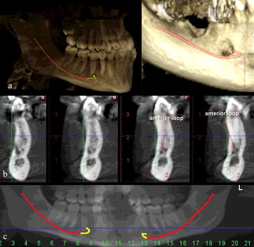 Figure 2. Three-dimensional CBCT (a), cross-sectional (b), panoramic reconstructed images (c) showing the mandibular canal and anterior loop.