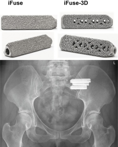 Figure 1 Top: triangular titanium implants for SIJ fusion. Left: machined iFuse implant (commercially available since 2009). Right: 3D-printed implant (iFuse-3D, commercially available since early 2017). Bottom: X-ray image of implants after placement across the left SIJ.