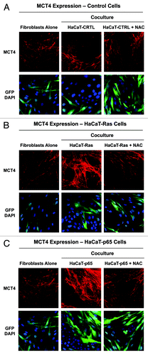 Figure 7. Oxidative stress mediates the upregulation of MCT4 in cancer-associated fibroblasts: rescue with NAC, a powerful antioxidant. HaCaT epithelial cells (control, H-Ras [G12V], or NFkB [p65]) were co-cultured for 5 days with hTERT-immortalized fibroblasts (GFP+). Then, the cells were fixed and immunostained with specific antibody probes. Note that MCT4 expression is increased most significantly in fibroblasts co-cultured with HaCaT-Ras cells and HaCaT-p65 cells, and that this can be reversed or prevented by the addition of the powerful antioxidant, N-acetyl cysteine (NAC) [10 mM], to the culture media. (A) HaCaT control co-cultures; (B) HaCaT-Ras co-cultures; (C) HaCaT-p65 co-cultures. DAPI (blue nuclear staining) is also shown for reference.