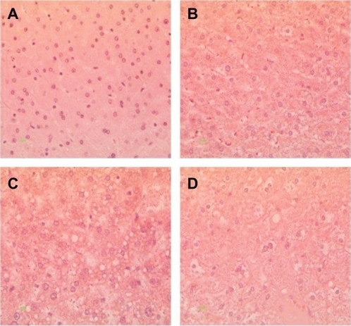 Figure 4 Hematoxylin and eosin staining of liver tissue from hamsters fed with hyperlipidemic diets. Magnification 400×. A) Normal diet, B) diet adequate in methionine and choline (5A4C), C) diet deficient in methionine and choline (5D4F), and D) diet adequate in methionine and deficient in choline (5D4E). Hepatocytes are filled with microvascular and macrovesicular fat deposits, leaving the nuclei in a central position, and the hepatocytes have assumed a very foamy appearance. Figure 5 Oil red O staining of liver tissue from hamsters fed on hyperlipidemic diets. Magnification 400×. A) Normal diet, B) diet adequate in methionine and choline (5A4C), C) diet deficient in methionine and choline (5D4F), and D) diet adequate in methionine and deficient in choline (5D4E). Hamster hepatocytes are filled with microvesicular and/or macrovesicular fat deposits; they are depicted as reddish-orange deposits, as shown with Oil red O staining.Display full size