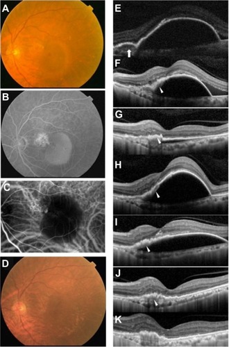 Figure 1 Findings from case 1, a 79-year-old Japanese man with a large PED in the left eye with PCV.