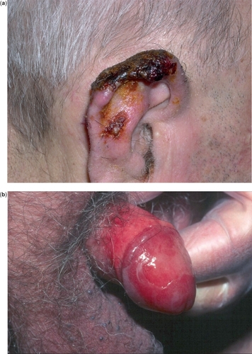 Figure 4 Local skin reactions during treatment with IQ 5% cream: crusting (a), marked erythema, erosion, and exudation (b).