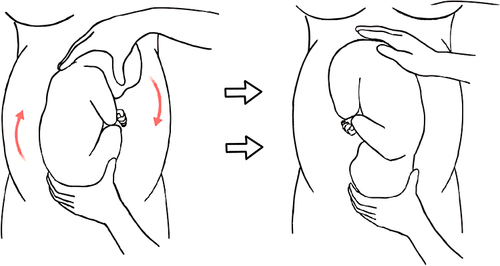 Figure 1 The fetal spine is on the right side of the abdomen. The practitioner used their right hand to hold the fetal head and their left hand to hold the fetal buttocks. The practitioner applied gentle pressure, pushing the fetal head toward the pubic symphysis in a clockwise forward roll motion with the right hand, while simultaneously guiding the fetal buttocks clockwise toward the uterine fundus with the left hand.