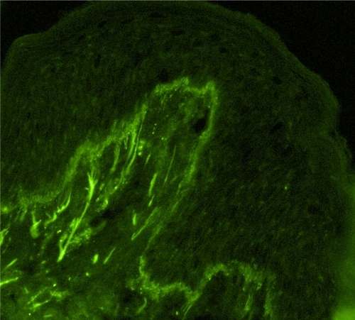 Figure 3 Partially homogenous, partially granular pattern of the lupus band test (immunoglobulin class M deposits, original magnification×200).