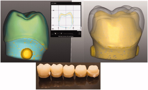 Figure 1. Representation of the process of scanning, designing and milling abutment models with different thicknesses used in this study.