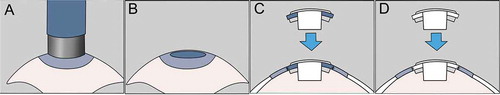 Figure 2. Schematical drawing of the surgical procedure. A. An 8.5 mm trephine is used to create a corneal pocket. B. The anterior chamber was irrigated with a heparin solution. C. The cornea-Kpro complex was placed in the recipient bed. D. The chondro-Kpro complex was placed in the recipient bed.