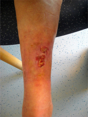 Figure 3 Leg lesion upon admission.