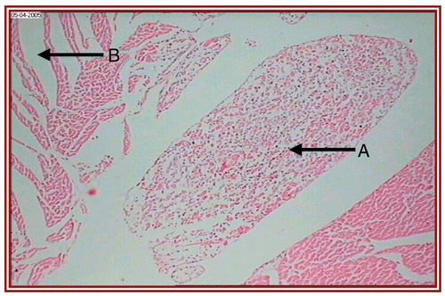 Figure 4.  ISO treated group (i.e., group IV) rat heart section, showing (A) marked inflammatory infiltrate with (B) edema (×10).