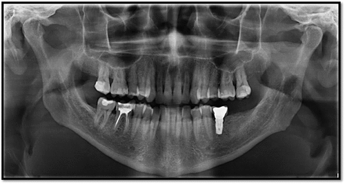 Figure 5. Orthopantomography of the IDU patient: signs of periodontal disease, with a thin periodontal pocket at the implantation of a tooth element.